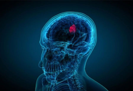 Use of Hydroxyurea in Combination Chemotherapy may Improve Treatment of Brain Tumor